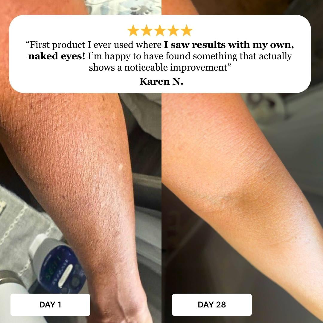 Before and after comparison photo of Karen N's arm showing significant reduction in crepey texture and dryness after using Love Restore soap for 28 days.